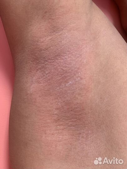 Шугаринг депиляция