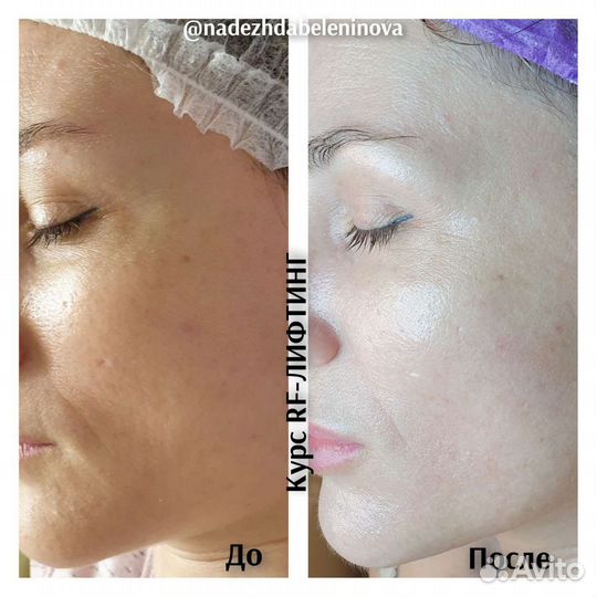 Вакуумный массаж, Кавитация, RF лифтинг