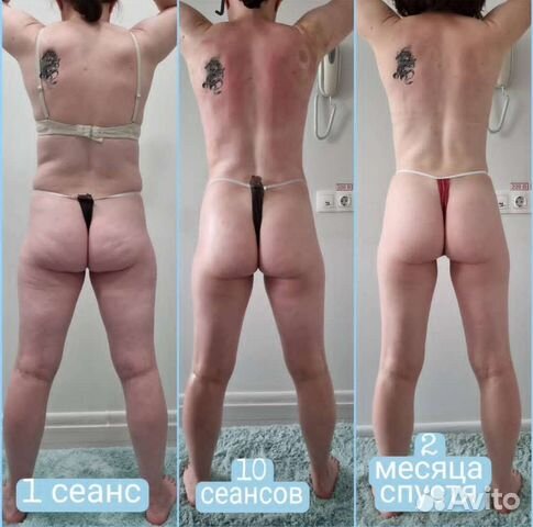 Массаж Антицеллюлитный старвак