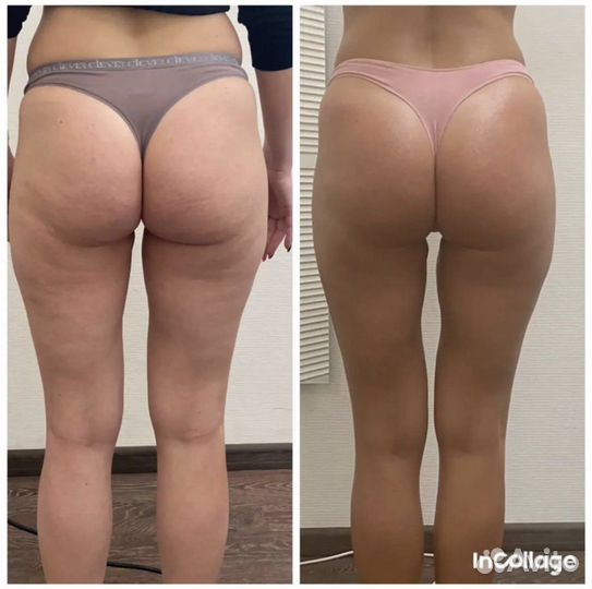 Vela Shape/Коррекция фигуры/rfлифтинг/узкавитация