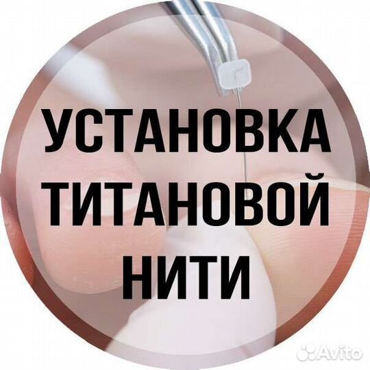 Установка титановой нити, установка тампонады