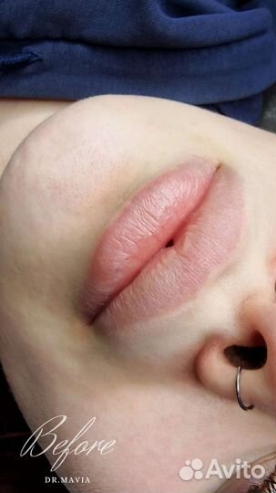 Увеличение губ