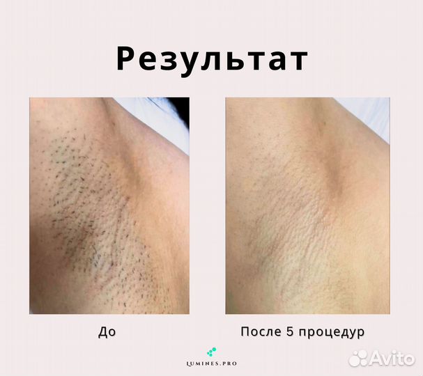 Диодный лазер Лю'Минес MaxOne 1200W