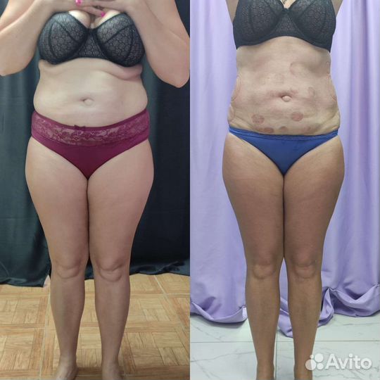 Вакуумный массаж, РФ- лифтинг, кавитация