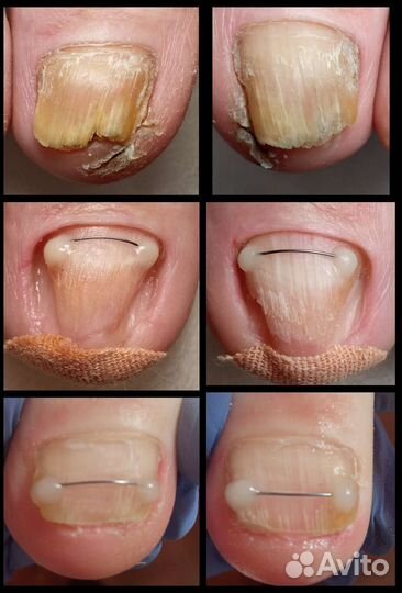 Подолог, вросший ноготь, сложный педикюр