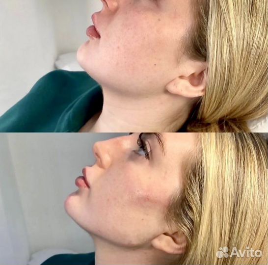 Контурная пластика лица