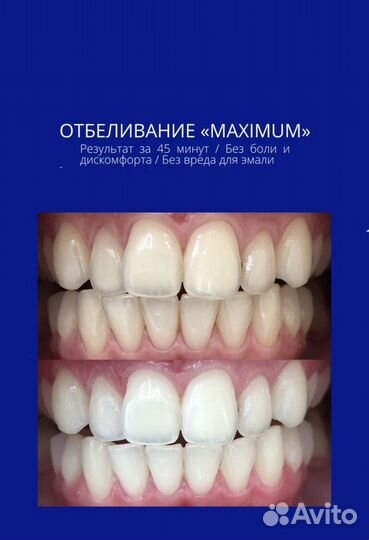 Косметическое Отбеливание зубов