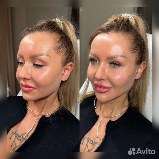 Безоперационная подтяжка лица