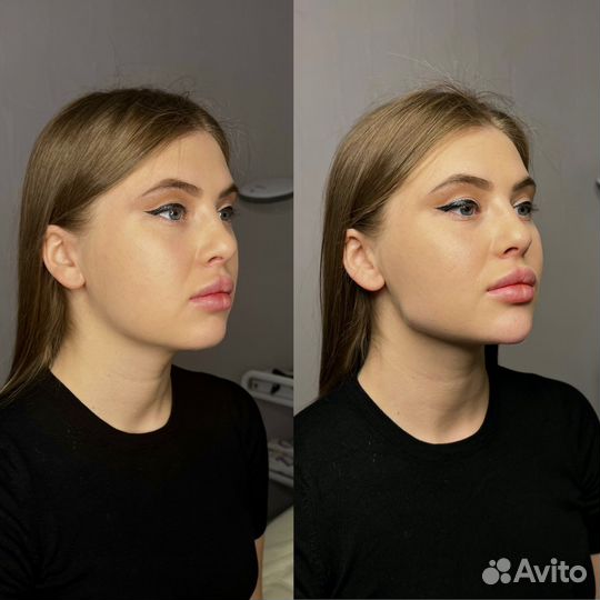 Требуются модели. Контурная пластика лица. Губы