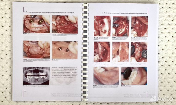 Регенеративные методы в имплантологии