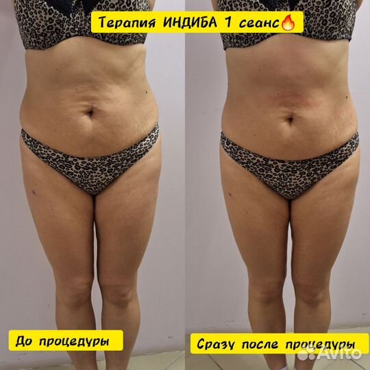 LPG массаж/вибро/вакуум/индиба