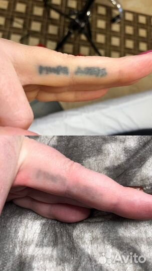 Удаление татуировок