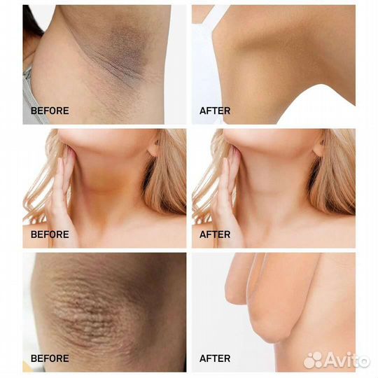 Отбеливание кожи