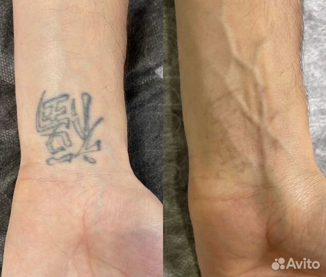 Удаление тату и татуажа на современном лазере