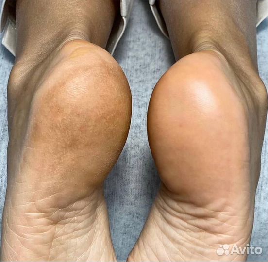 Смарт-пилинг