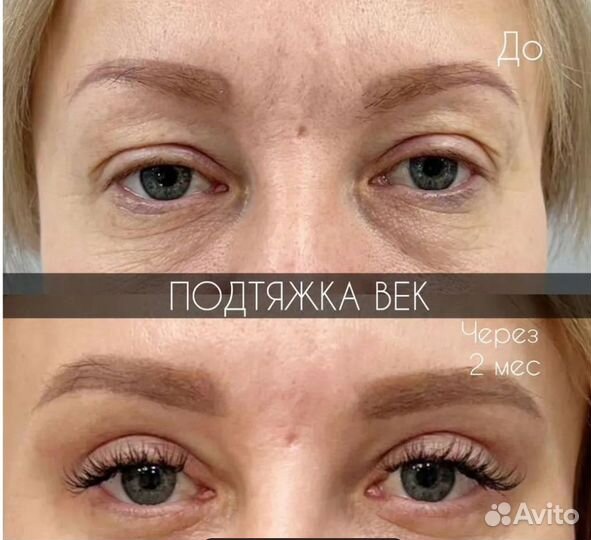 Супер омоложение и подтяжка лица без уколов