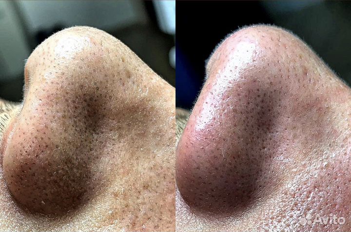 Классический массаж лица