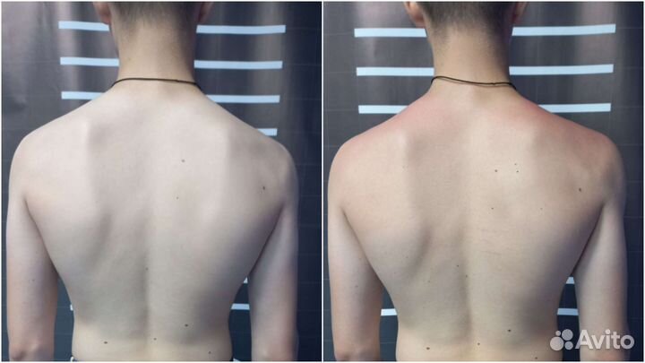 Плоскостопие, позвоночник, реабилитация