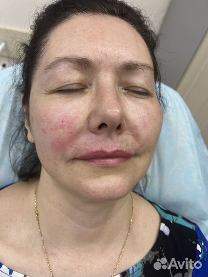 Плазмолифтинг