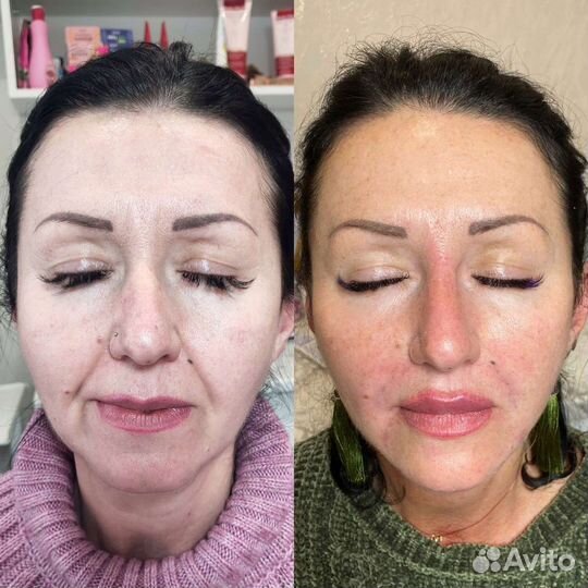 Коррекция носогубных морщин