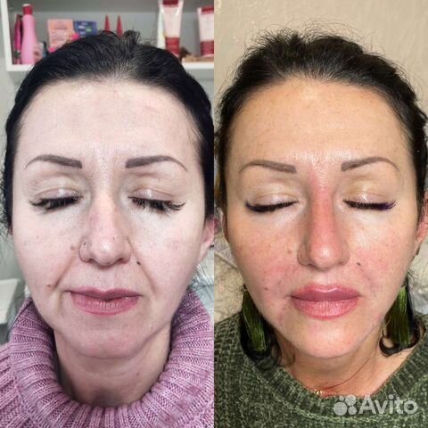 Коррекция носогубных морщин