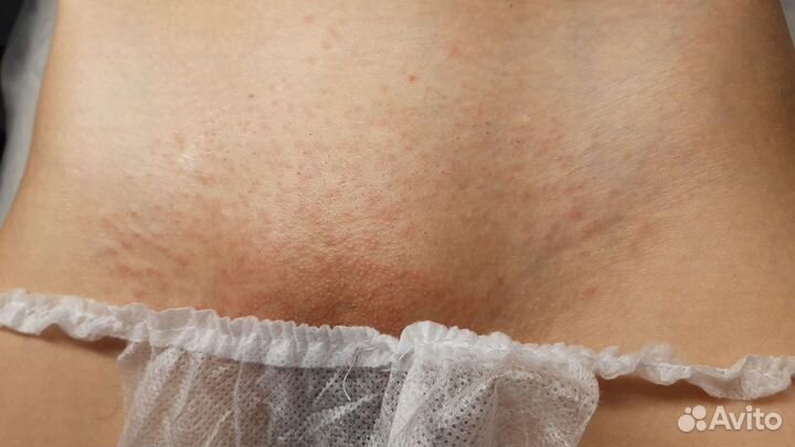 Электроэпиляция