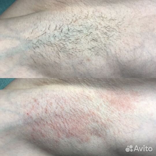 Электроэпиляция
