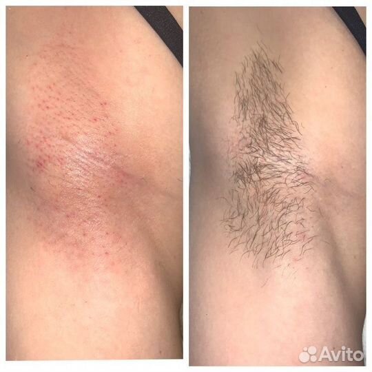 Женская и мужская Депиляции