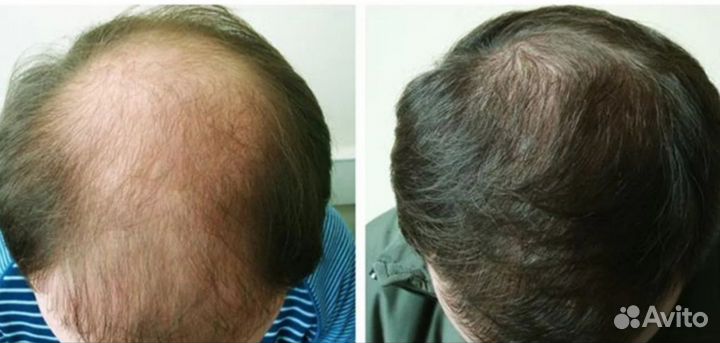 Восстановление роста и густоты волос