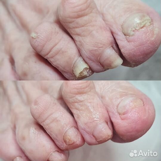 Подолог - медицинский педикюр