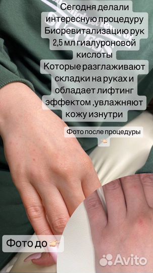 Увеличение губ