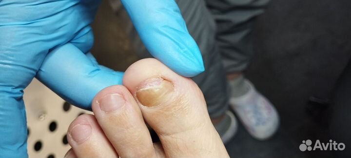 Установка титановой нити