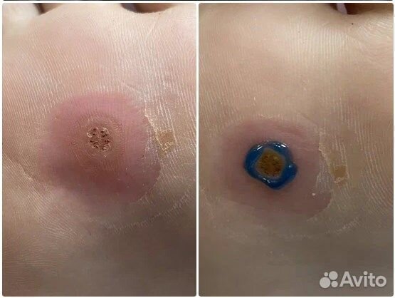 Удаление стержневых мозолей, подолог