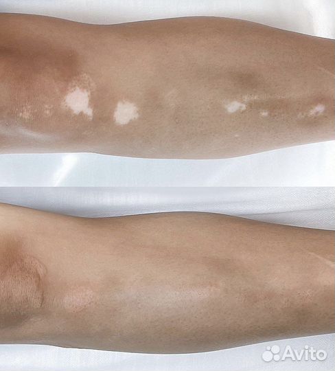 Камуфляж шрамов, рубцов, растяжек, витилиго