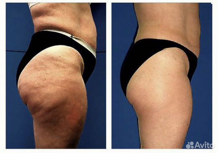 Кавитация ультразвуковая-коррекция фигуры