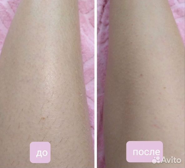 Лазерная эпиляция/элос эпиляция