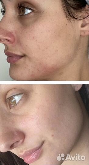 Пилинг вокруг глаз