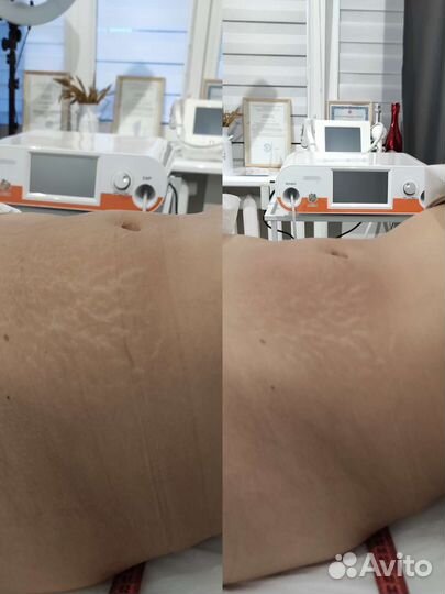 Массаж ручной Массаж lpg Косметолог