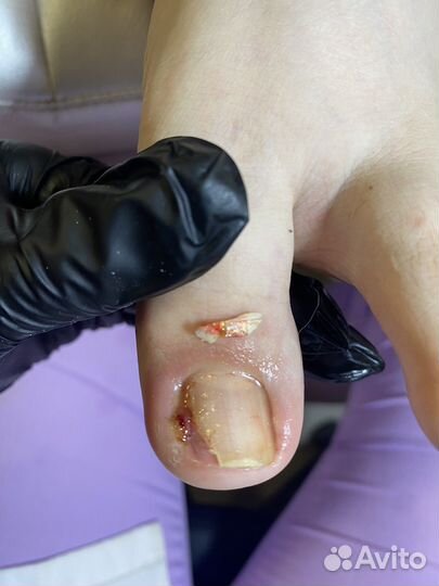 Установка титановой нити