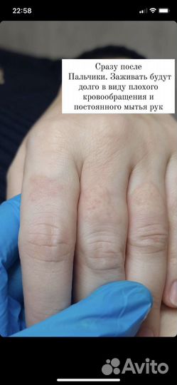 Электроэпиляция