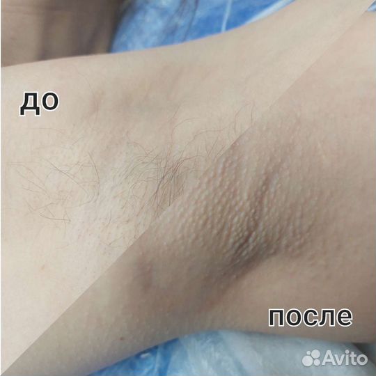 Депиляция