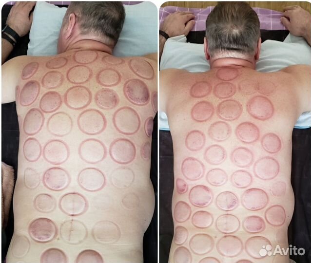 Массаж банками