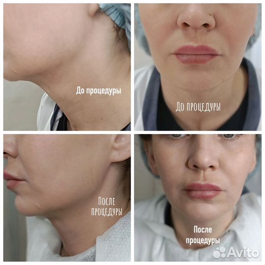 Смас лица, тела, подтяжка фигуры