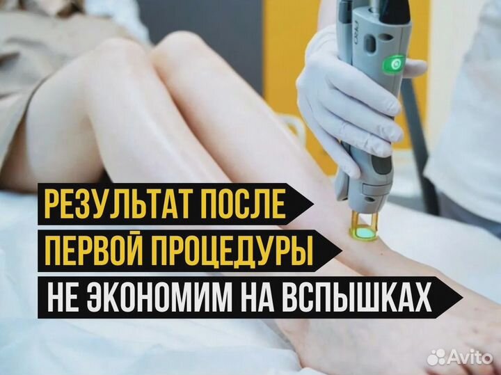 Лазерная эпиляция