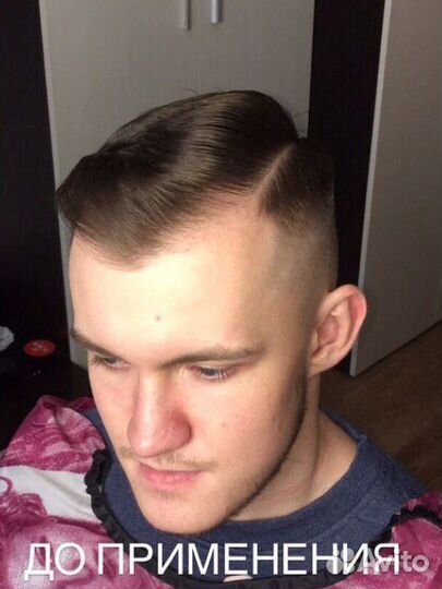 Миноксидил