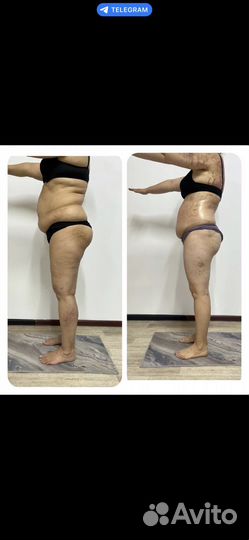 Коррекция фигуры снижение веса