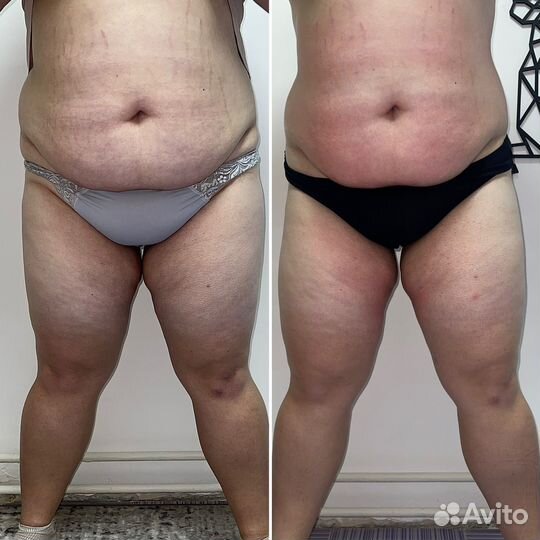 Аппаратный массаж