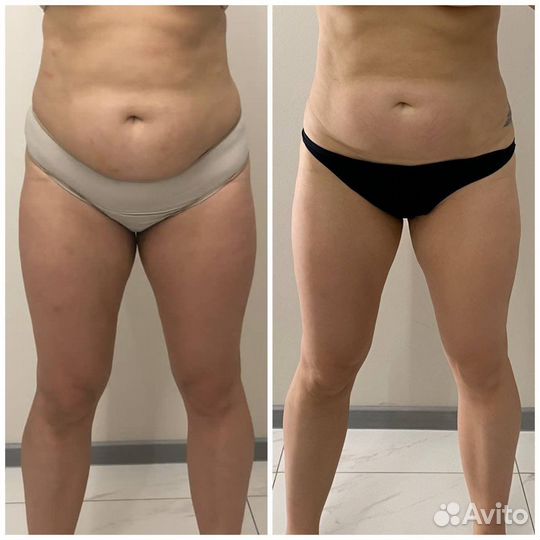 Массаж коррекция фигуры(жиротоп)