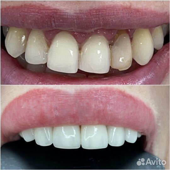 Виниры на зубы