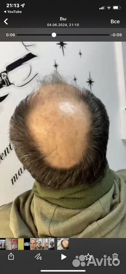 Трихопигментация головы smp тату волос